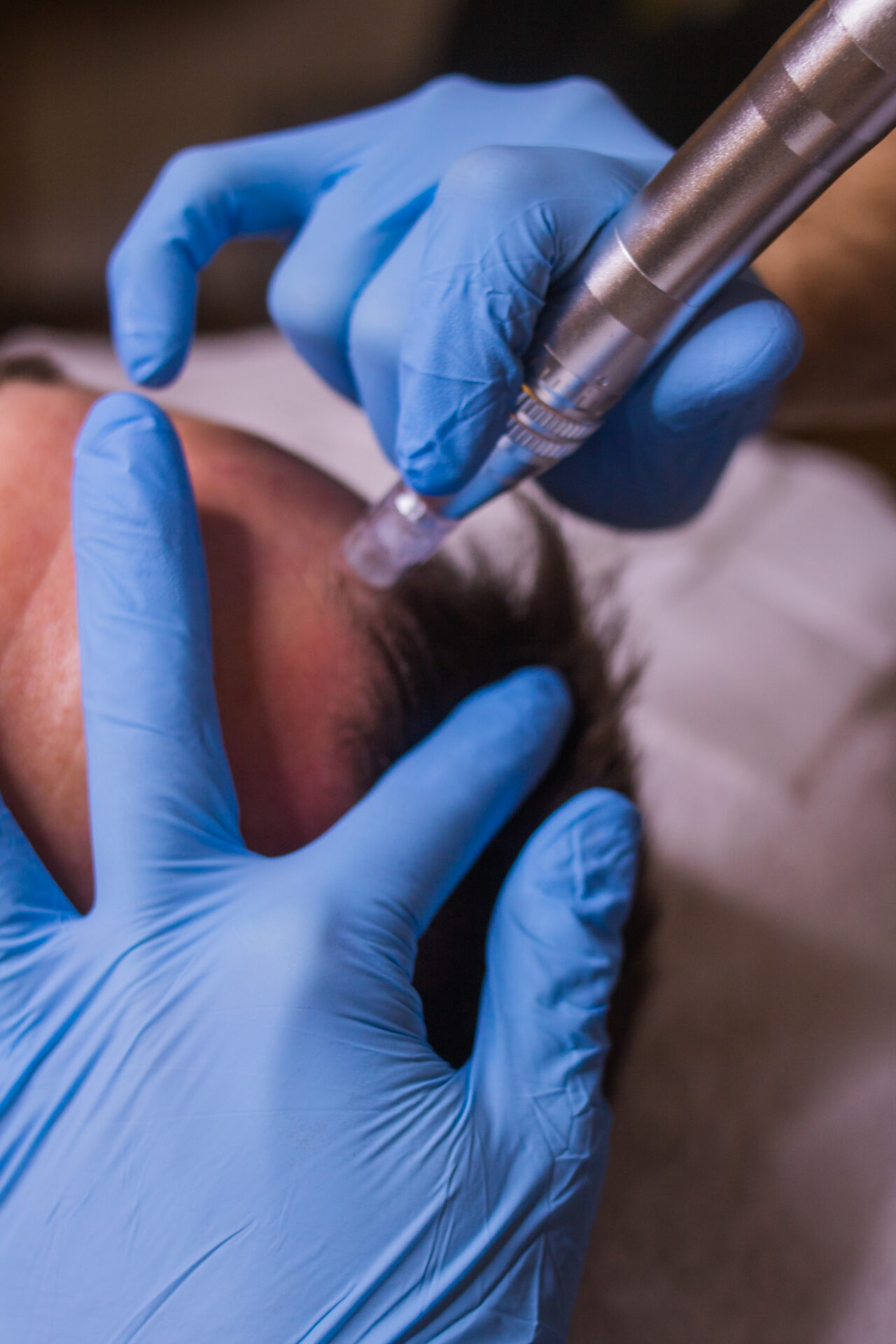 Understanding the Difference Between Micro and Nano Needling for Skin Rejuvenation